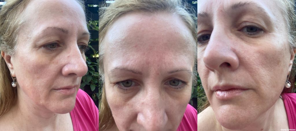 Colaj before – testare Foreo BEAR 2 și Supercharged Serum 2.0 Colaj cu 3 imagini before – fața Oanei Grecea înainte de utilizarea Foreo BEAR 2, în cadrul testării efectelor microcurenților.